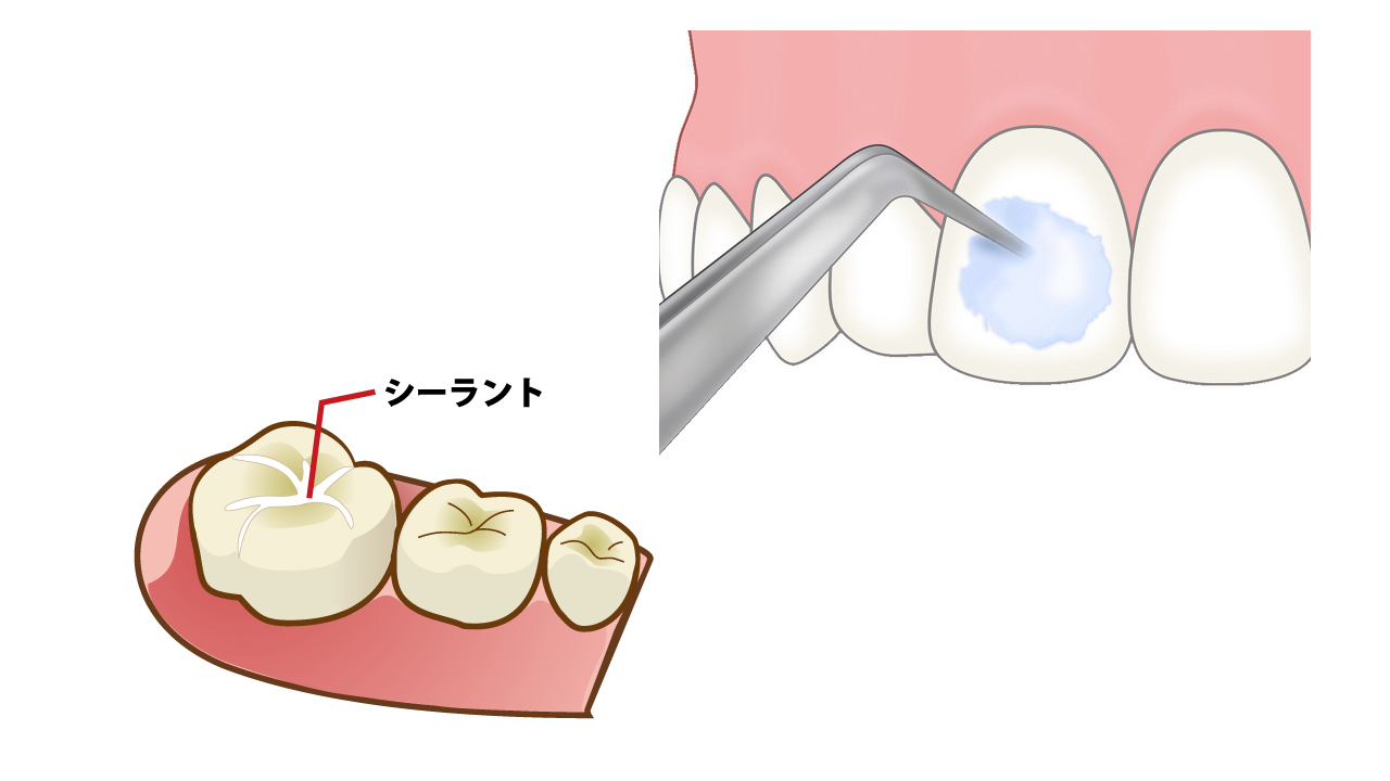虫歯予防