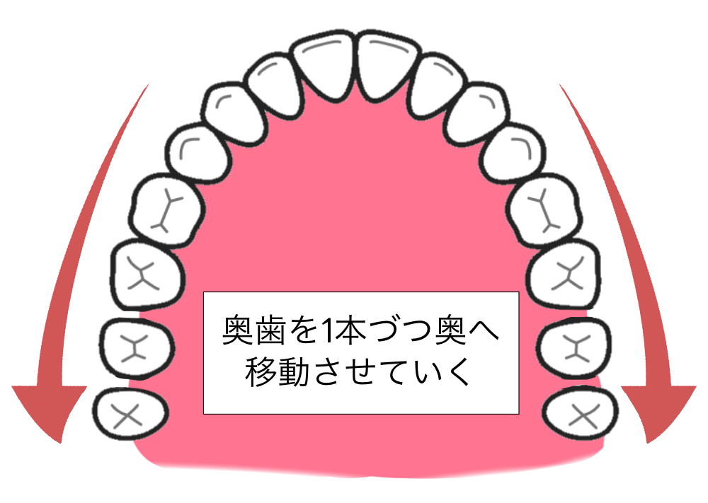 歯を後ろに送る【臼歯遠心移動】